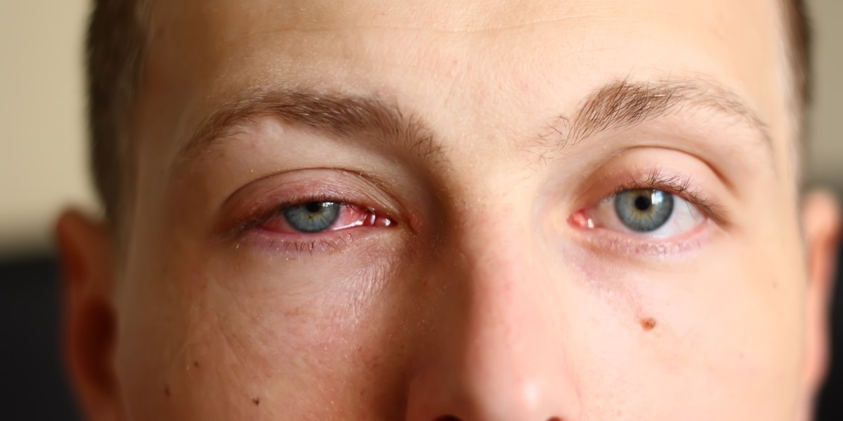 Os 6 Sintomas das Alergias oculares